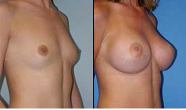breast_enlargement_photos.jpg